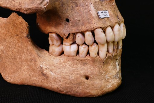 Das Foto zeigt die rechte Seite eines Kiefers. Im Oberkiefer ist ein Zahn an Karies erkrankt, dass dadurch entstandenen Loch zog sich tief bis in die Zahnwurzel hinein und eindringende Bakterien verursachten eine eitrige Entzündung im Kieferknochen