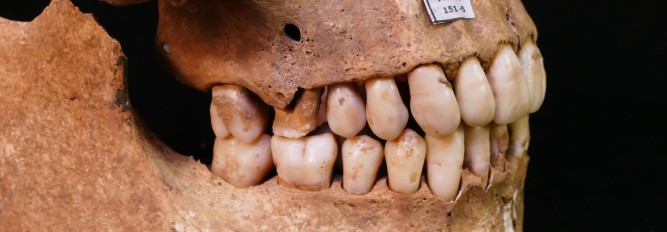 Das Foto zeigt die rechte Seite eines Kiefers. Im Oberkiefer ist ein Zahn an Karies erkrankt, dass dadurch entstandenen Loch zog sich tief bis in die Zahnwurzel hinein und eindringende Bakterien verursachten eine eitrige Entzündung im Kieferknochen